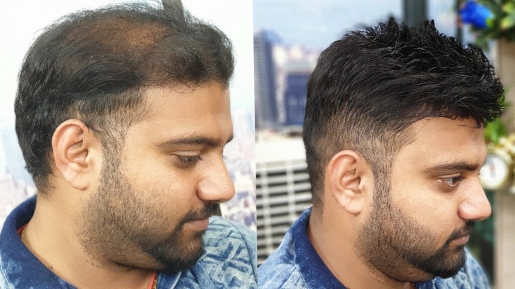A COMPLETE GUIDE ABOUT NON-SURGICAL HAIR REPLACEMENT SYSTEMS
