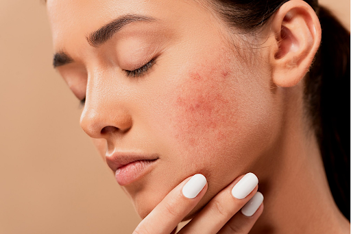 5 Kitchen Ingredients to Get Rid Of Skin Hyperpigmentation