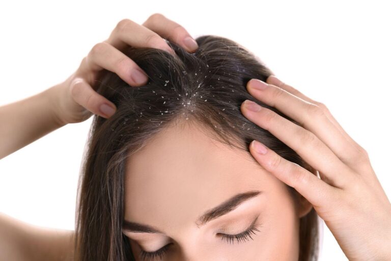 The Best Hair Oil For Dandruff