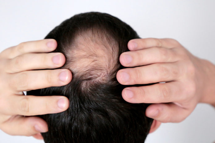 best hair thinning treatments scaled